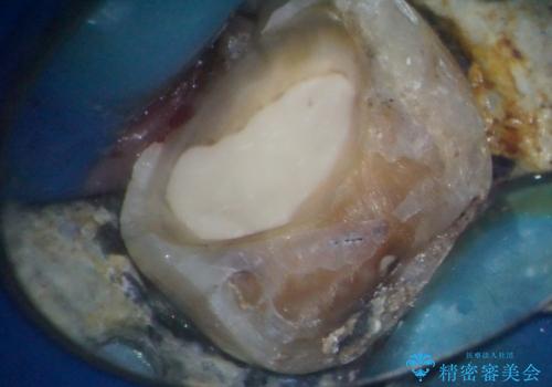 奥歯がしみる　オールセラミッククラウンによる奥歯のむし歯治療の治療後