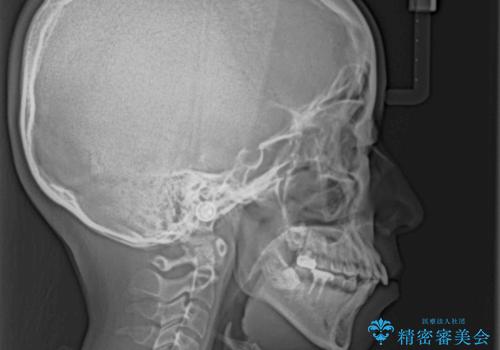 【モニター】唇が閉じにくい　ワイヤー装置での抜歯矯正の治療前