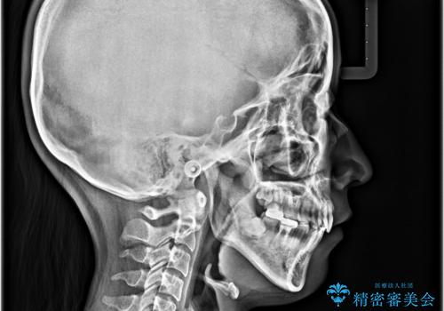 【モニター】唇が閉じにくい ワイヤー装置での抜歯矯正の治療後