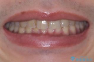 目立たない矯正で正中離開と下の前歯のデコボコを改善|インビザラインによる治療症例の治療後(顔貌)