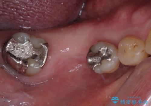 抜歯して放置したままの奥歯　即時荷重インプラント