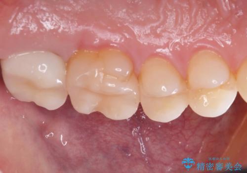 【メタルフリー】銀歯を綺麗な白い歯にの治療後