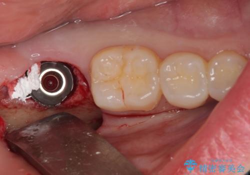 抜歯になった奥歯　速やかな埋入による短期間インプラント治療の治療前