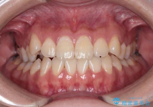 【審美ワイヤー】八重歯とがたつき気になるの症例 治療前