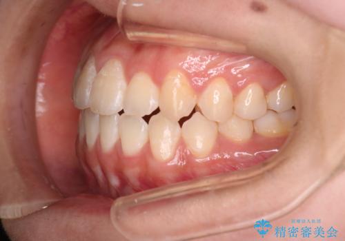 【審美ワイヤー】八重歯とがたつき気になるの治療後