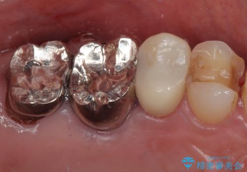 欠けた詰め物を精密セラミックインレーで自然に修復した症例の症例 治療前