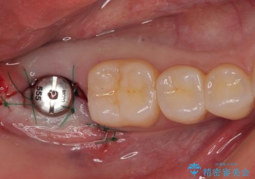 抜歯になった奥歯 速やかな埋入による短期間インプラント治療の治療中
