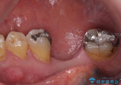 抜歯して放置したままの奥歯 即時荷重インプラントの治療前