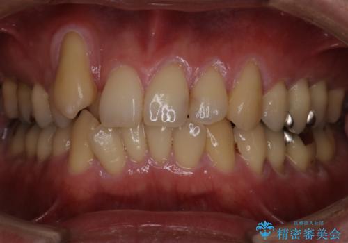 【メタル装置】1本のみ抜歯してワイヤー矯正の症例 治療前