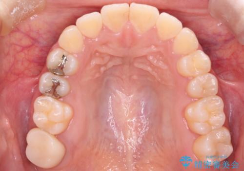 【審美ワイヤー】八重歯とがたつき気になるの治療後