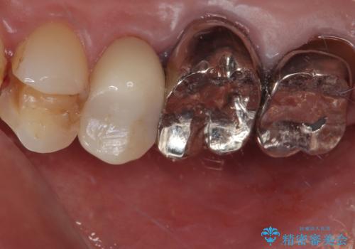 欠けた詰め物を精密セラミックインレーで自然に修復した症例の治療前