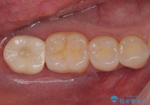 抜歯になった奥歯　速やかな埋入による短期間インプラント治療