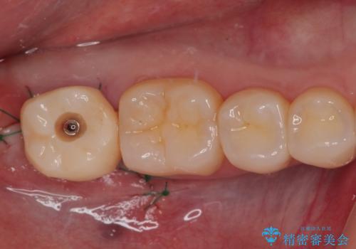 抜歯になった奥歯　速やかな埋入による短期間インプラント治療の治療中