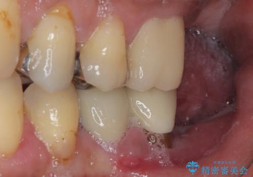 割れて揺れている奥歯　抜歯即時・早期埋入インプラント治療の治療前