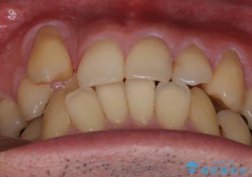 【メタル装置】1本のみ抜歯してワイヤー矯正の治療前