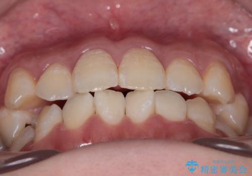 【審美ワイヤー】八重歯とがたつき気になるの治療前