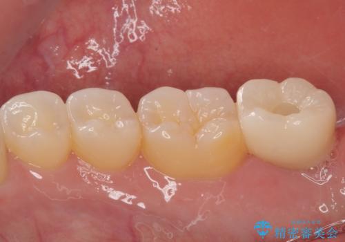 抜歯になった奥歯 速やかな埋入による短期間インプラント治療の治療後