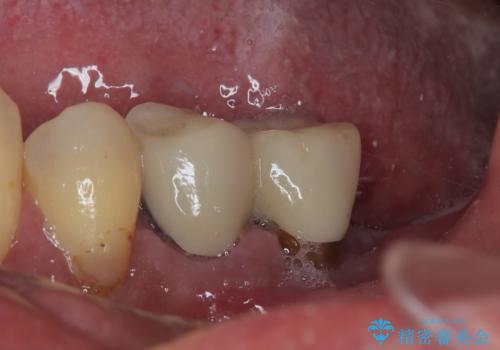 割れて揺れている奥歯 抜歯即時・早期埋入インプラント治療の治療前