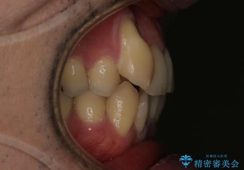 【メタル装置】1本のみ抜歯してワイヤー矯正の治療前