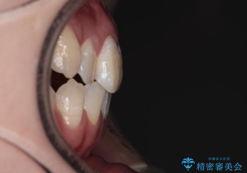 【審美ワイヤー】八重歯とがたつき気になるの治療前