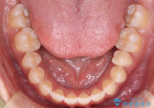 【審美ワイヤー】八重歯とがたつき気になるの治療後