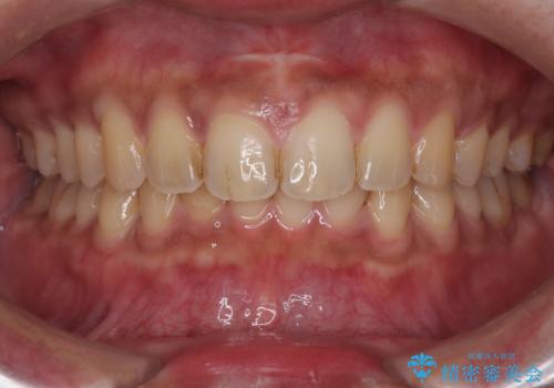 目立たない矯正で正中離開と下の前歯のデコボコを改善|インビザラインによる治療症例の症例 治療後