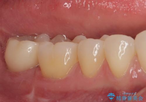 抜歯になった奥歯　速やかな埋入による短期間インプラント治療の治療後