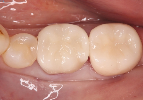 話すときに銀歯が見えて気になる　セラミックでキレイに治す!