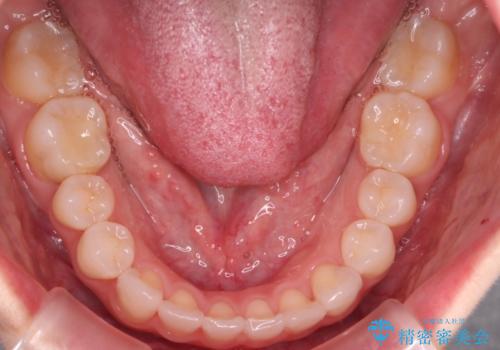 【審美装置】非抜歯矯正で八重歯改善!の治療後