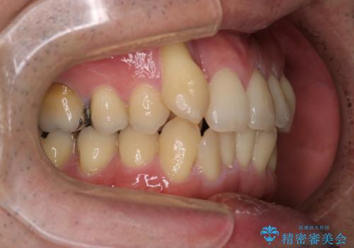 【メタル装置】1本のみ抜歯してワイヤー矯正の治療前