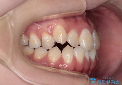【審美ワイヤー】八重歯とがたつき気になるの治療前
