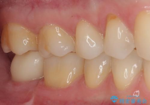 抜歯になった奥歯　速やかな埋入による短期間インプラント治療の治療後