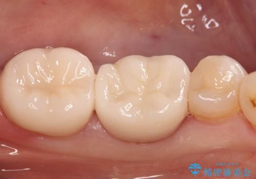 話すときに銀歯が見えて気になる　セラミックでキレイに治す!の治療後