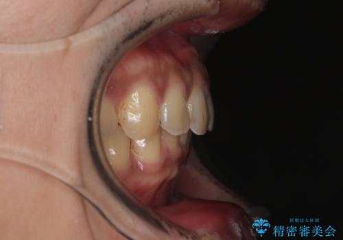 目立たない矯正で正中離開と下の前歯のデコボコを改善|インビザラインによる治療症例の治療後