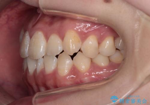 【審美ワイヤー】八重歯とがたつき気になるの治療前