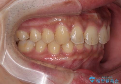目立たない矯正で正中離開と下の前歯のデコボコを改善|インビザラインによる治療症例の治療後