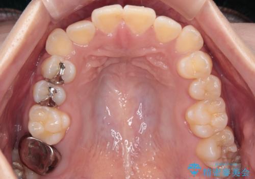 【審美ワイヤー】八重歯とがたつき気になるの治療前