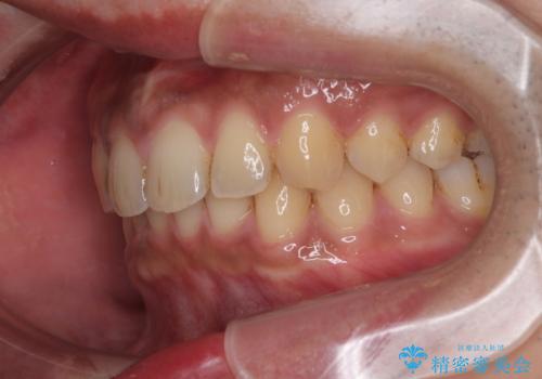 目立たない矯正で正中離開と下の前歯のデコボコを改善|インビザラインによる治療症例の治療後