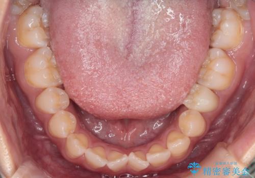 【審美ワイヤー】八重歯とがたつき気になるの治療前