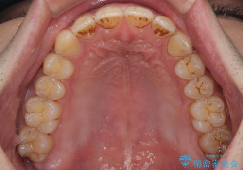 目立たない矯正で正中離開と下の前歯のデコボコを改善|インビザラインによる治療症例の治療後