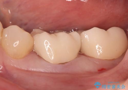 話すときに銀歯が見えて気になる　セラミックでキレイに治す!の治療後