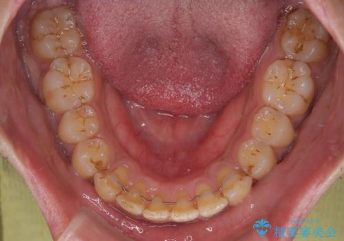 目立たない矯正で正中離開と下の前歯のデコボコを改善|インビザラインによる治療症例の治療後