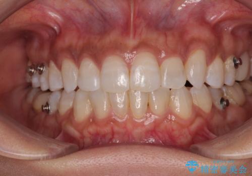 クロスバイトを治したい インビザラインによる矯正治療の治療中