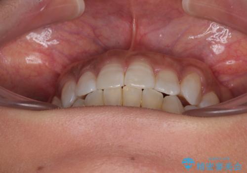 クロスバイトを治したい　インビザラインによる矯正治療の治療中