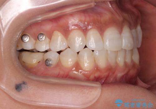 クロスバイトを治したい　インビザラインによる矯正治療の治療中