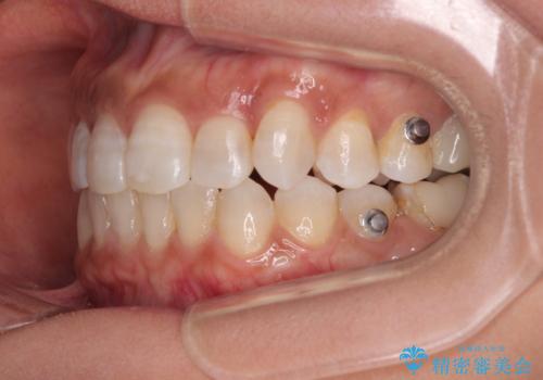 クロスバイトを治したい インビザラインによる矯正治療の治療中