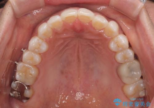 クロスバイトを治したい インビザラインによる矯正治療の治療中