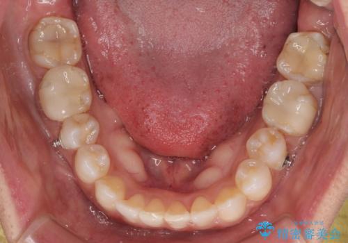 クロスバイトを治したい インビザラインによる矯正治療の治療中