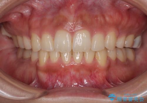 【モニター】唇が閉じにくい ワイヤー装置での抜歯矯正の症例 治療後