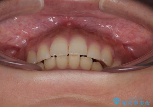 【モニター】唇が閉じにくい　ワイヤー装置での抜歯矯正の治療後